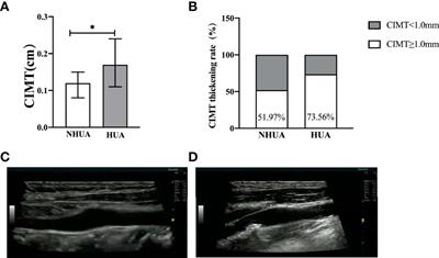 Association Between Serum Uric Acid and Carotid Intima-Media Thickness in Different Fasting Blood Glucose Patterns: A Case-Control Study